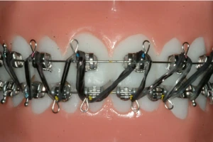 Rubber Band Wear - Orthodontist Vancouver WA, Braces and Invisalign