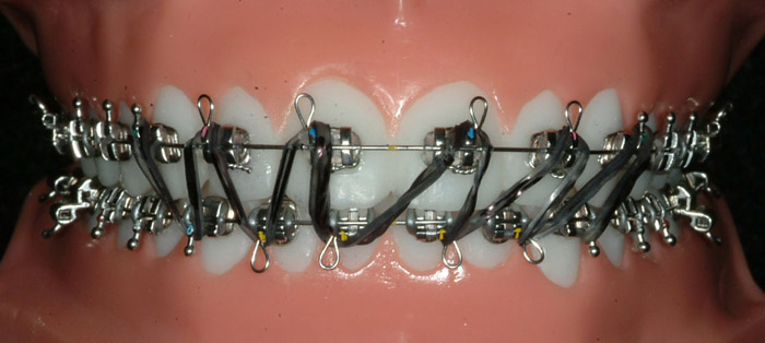rubber band hook for braces